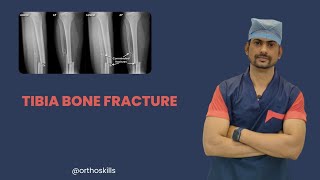 Tibia Bone FractureTibia Bone Fracture typesTibia Bone Fracture kya h [upl. by Netty]