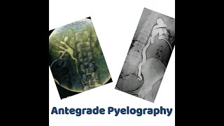 antegrade Pyelography [upl. by Woodford240]