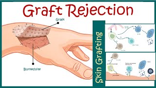 Graft rejection  Immunological basis of graft rejection [upl. by Allac]