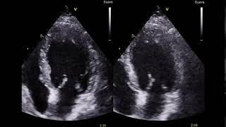 Video 1  Ecocardiograma de estrés  Proyección 4 cámaras [upl. by Kirtap561]