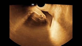 caudal regression syndrome fetal ultrasound with phocomelia of lower extremeties [upl. by Ecnatsnok726]