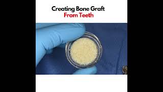 Creating Bone Graft From Ground up Natural Teeth [upl. by Hutner]