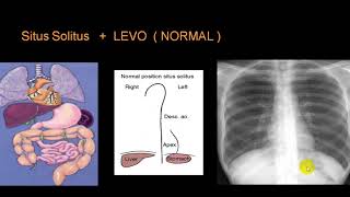 DEXTROCARDIA [upl. by Edroi63]