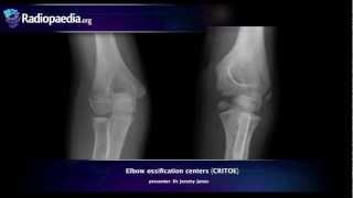 Elbow ossification centers CRITOE  radiology video tutorial [upl. by Kilam]