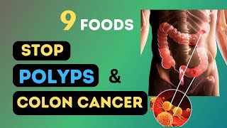 9 Miracle Foods to Eliminate Colon Polyps amp Stop Bowel Cancer [upl. by Yeloc]