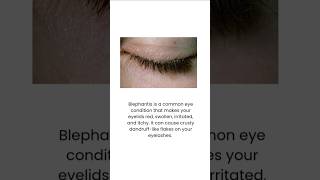 Blepharitis is inflammation of lidsblepharitis dandruff eyelasheswhat is blepharitis [upl. by Adnorrehs498]