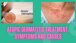 Atopic dermatitis treatment symptoms and causes  Nuse Healthy [upl. by Akehsyt]