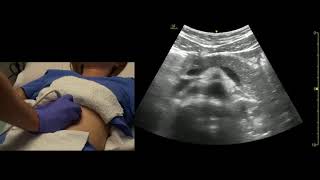 Abdominal Aorta and Pancreas Ultrasound Scanning Technique [upl. by Acsot105]