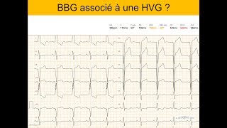 Hypertrophie ventriculaire gauche et bloc de branche  Quiz Dr Taboulet [upl. by Estus]