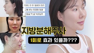 얼굴 지방분해주사 후기  ❌스테로이드  땅콩형얼굴  윤곽주사  광대주사 [upl. by Olette]