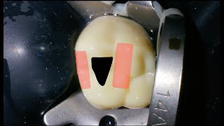 Maxillary First Molar Access Cavity Preparation [upl. by Aronal993]