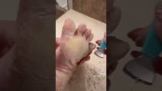 Foot peel mask series  TikTok Compilation 2  Do foot peeling masks work with EPPK Keratoderma [upl. by Corby591]