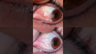 Pterygium  Sivam clinic GV eye care ophthalmologist [upl. by Tenaj533]