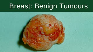 Breast Benign Tumours  Pathology mini tutorial [upl. by Ike]