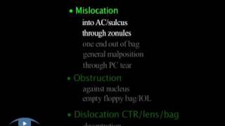 Capsular Tension Rings Complications Phaco 34 Complications [upl. by Drews]