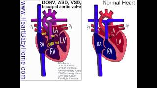 38 Double Outlet Right Ventricle with ASD VSD bicuspid aortic [upl. by Jann]