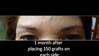 Eyebrow Transplantation in the Philippines and Asiawmv [upl. by Pomfrey508]