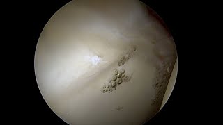 Debonded Articular Cartilage Lifting off the Bone as Labrum is Stressed [upl. by Raffo]