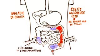 Maladie Inflammatoire de Lintestin MII [upl. by Anerdna]