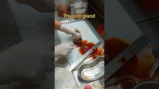 Cystic thyroid gland gross pathology [upl. by Ajiat]