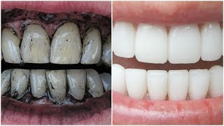 3 Way to Whiten Your Yellow Teeth Naturally [upl. by Leanor]