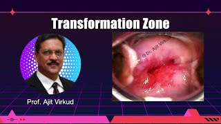 Tranformation Zone Masterclass [upl. by Lirba]