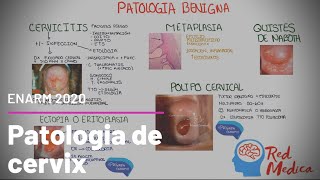 Cancer cervicouterino CaCU cervicitis y otra patología de cervix ENARM [upl. by Sidnac]