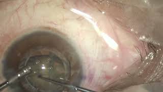 Robotic Cataract Surgery [upl. by Zedecrem]