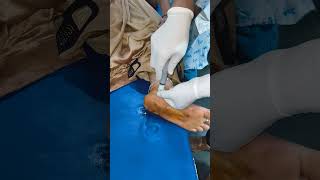 INTRAARTICULAR INJECTION FOR ANKLE PAIN [upl. by Harper663]