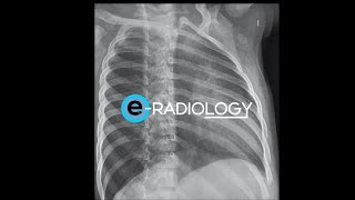 Cuáles son las PROYECCIONES ESPECIALES de la radiografía de TÓRAX 🩻  Todo lo que necesitas saber [upl. by Hekker]