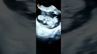 OVARIAN CYSTIC TERATOMA DERMOID CYST [upl. by Amme]