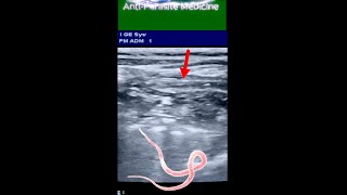 Long Ascaris Worm  in Small Intestine of 8 yrs Old Boy ultrasound [upl. by Yllom133]