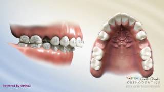 Upper 2nd Bicuspid Extraction  Overjet  Orthodontic Treatment [upl. by Rahr332]