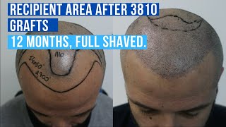 Hair Transplant Turkey 3810 Grafts No DHI Hair Transplant 2020 [upl. by Pulsifer]