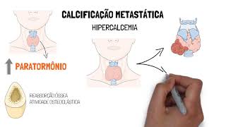 Calcificações patológicas  Distróficas e Metastáticas [upl. by Carlick]