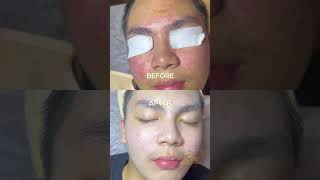 Teenage Acne Acne Awareness Month  My Cozy Room Best Extraction Facial Singapore PART 2 [upl. by Zaremski]