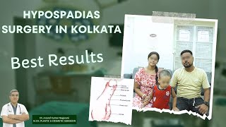 Hypospadias Surgery In Kolkata  Hypospadias Problem amp Solution  Best Result [upl. by Keith]