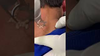 laser tattoo removal  Laser tattoo removal results  Skinaa Clinic shorts viral [upl. by Anerul514]