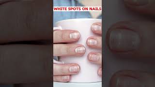 White Spots on Nails Causes and Solutions [upl. by Gian]