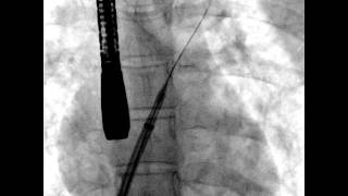 Atrial septal defect StepbyStep catheter closure Vol1 Issue 1  Video 11 [upl. by Aztiraj]