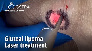 Gluteal lipoma  Laser treatment  24146 [upl. by Aierb]