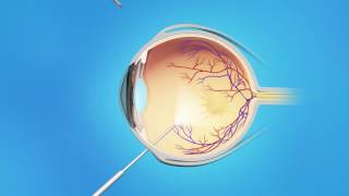 Macular Pucker Vitrectomy Surgery [upl. by Ttoille]