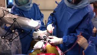 Total Hip Replacement Using MAKO Robotic Assistance [upl. by Yecac427]