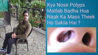 Nose Polyps  Naak Ka Mass Badh Jana Ka Bahut Hi Easy Upchar [upl. by Romona]