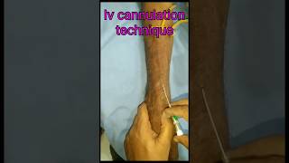 Iv cannulation techniquenursing motivation viralvideo mbbs shorts [upl. by Nelad]