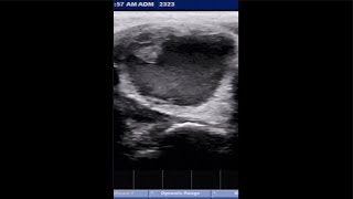 THYROID CYST ultrasound hormones thyroid [upl. by Anual]