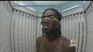 Doctor Says Vitiligo Can Be Treated [upl. by Gladdie]