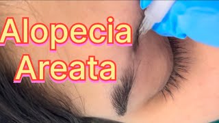 Alopecia Areata [upl. by Coretta]