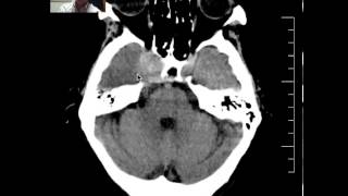 Head CT of Meningioma DISCUSSION by radiologist [upl. by Ojyma]