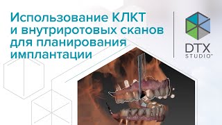 Использование КЛКТ и внутриротовых сканов для планирования имплантации  DTX Studio Clinic [upl. by Lleraj]